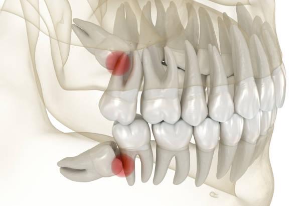 Wisdom teeth removal